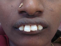 before dental treatment